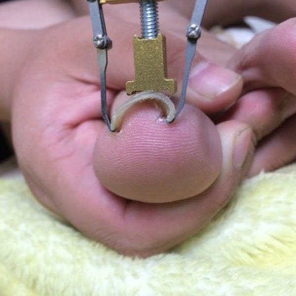 Professional Ingrown Toenail Thick Paronychia Correction Tool Pedicure Manicure Nail Nipper Silver Gold