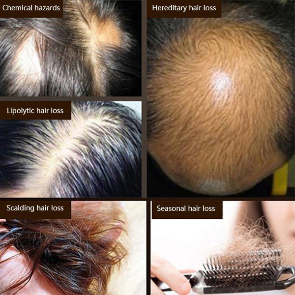 250ml Hair Loss Care Shampoos Growth Natural Herb Effective Solution Hair Thinning Breakage