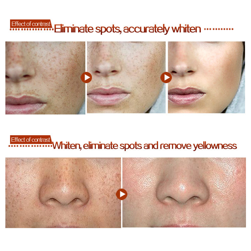 Age Spot Melasma Remove Freckle Face Cream Whitening Lightening Skin Care