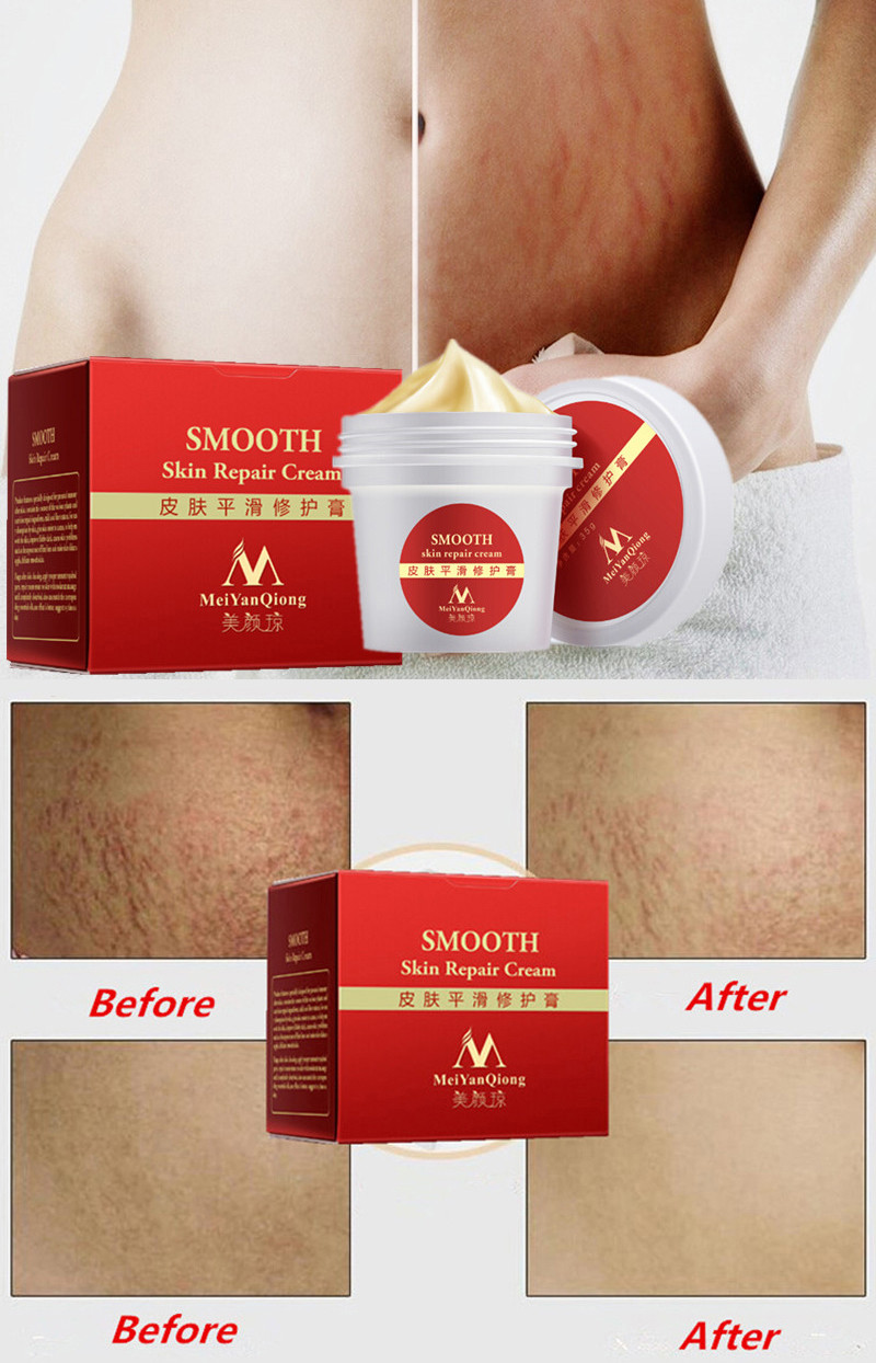 MeiYanQiong Stretch Marks Repairing Cream Scar Removal Maternity Skin Care Postpartum Smooth